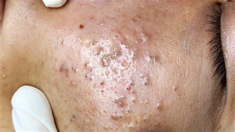 pimples treatment by doctor. . Cystic acne sac dep spa 2022